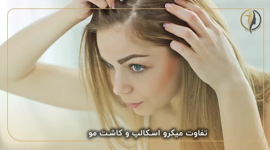 تفاوت میکرو اسکالپ و کاشت مو