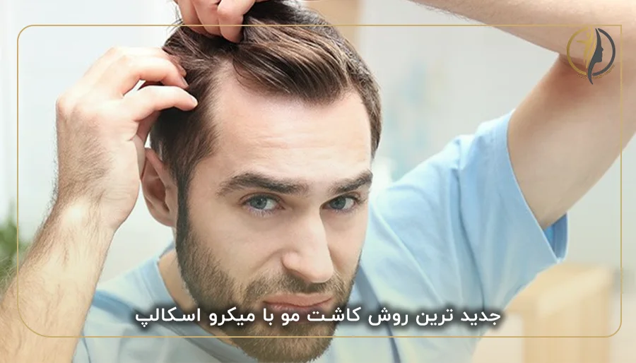 جدید ترین روش کاشت مو با میکرو اسکالپ