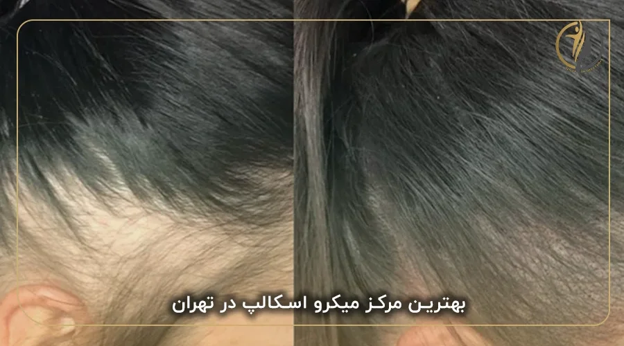بهترین مرکز میکرو اسکالپ در تهران
