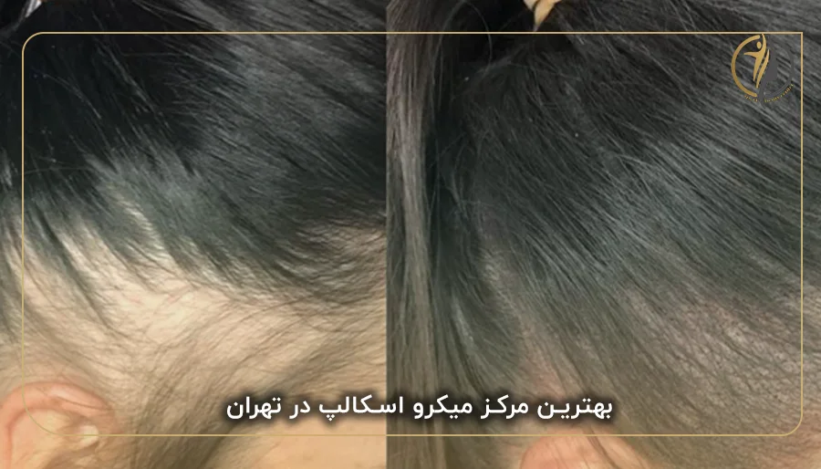 بهترین مرکز میکرو اسکالپ در تهران