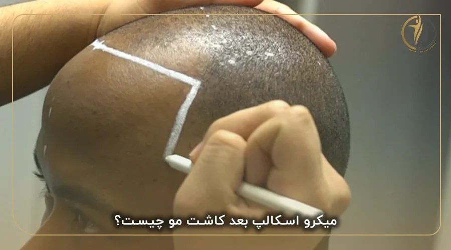 میکرو اسکالپ بعد کاشت مو چیست؟
