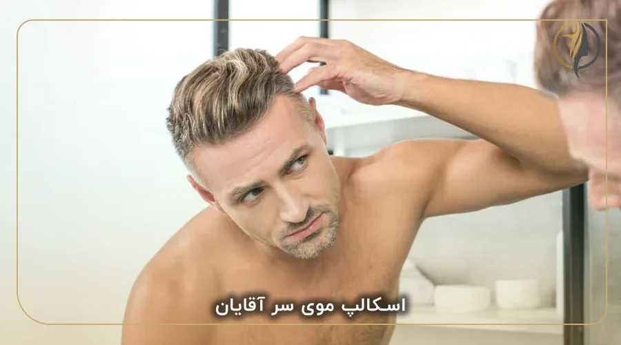 اسکالپ موی سر اقایان