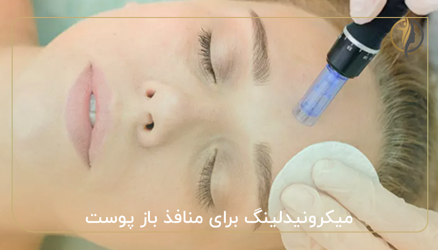 میکرونیدلینگ برای منافذ باز پوست