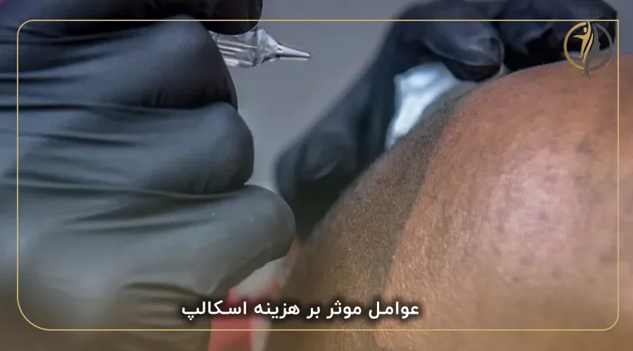 عوامل موثر بر هزینه اسکالپ