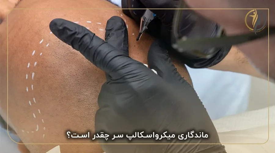 ماندگاری میکرواسکالپ سر چقدر است؟