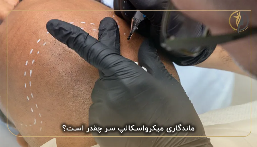 ماندگاری میکرواسکالپ سر چقدر است؟