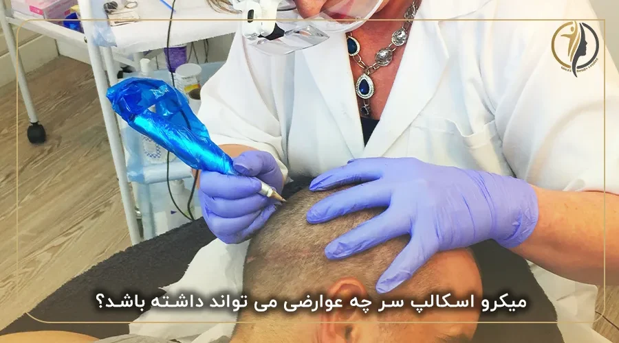 میکرو اسکالپ سر چه عوارضی می تواند داشته باشد؟