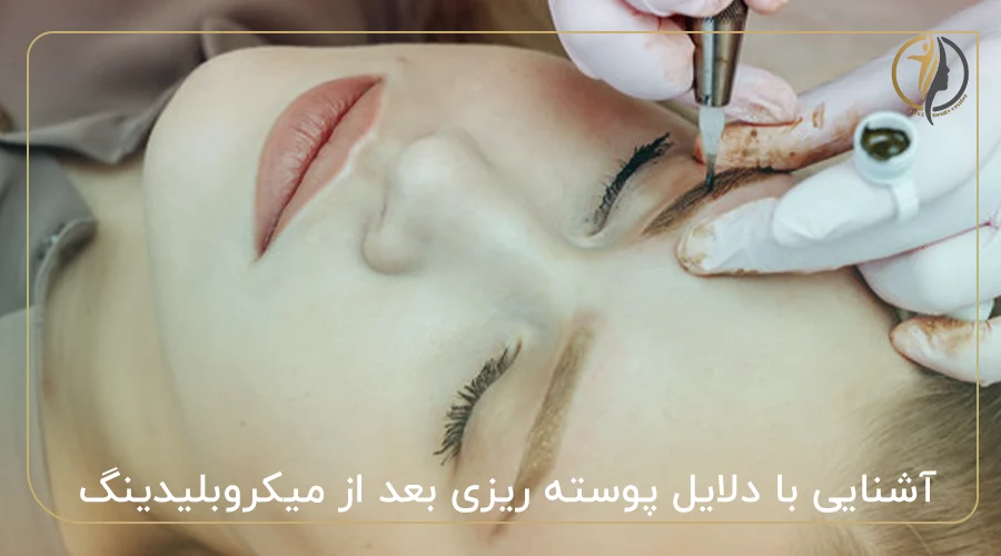 آشنایی با دلایل پوسته ریزی بعد از میکروبلیدینگ