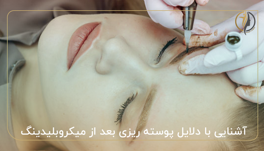 آشنایی با دلایل پوسته ریزی بعد از میکروبلیدینگ