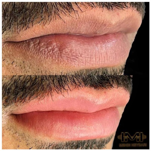 میکروبلیدینگ ریش و سیبیل