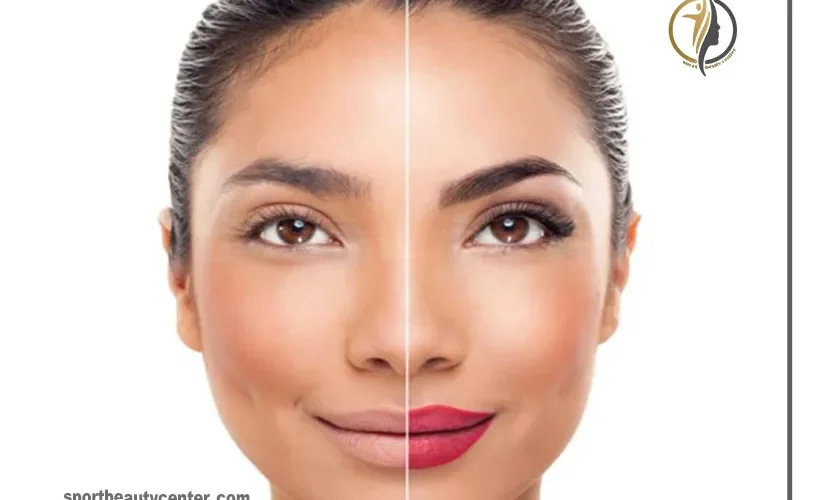 میکروپیگمنتیشن