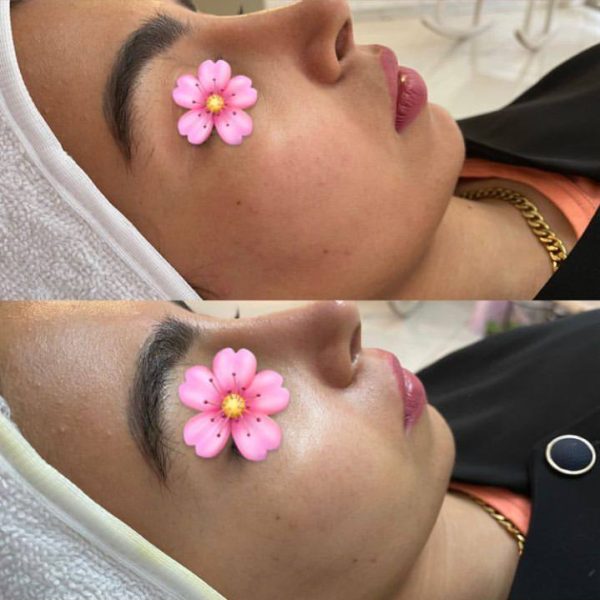 facial