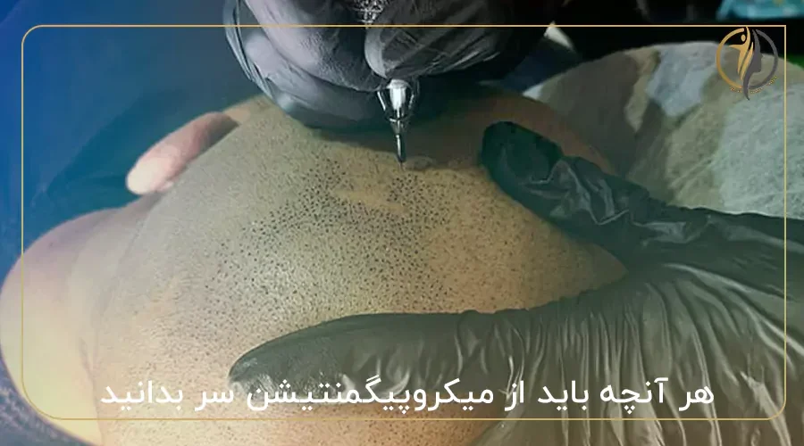 هر آنچه باید از میکروپیگمنتیشن سر بدانید!