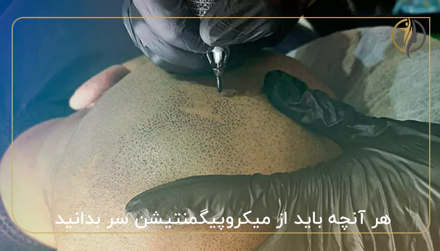 هر آنچه باید از میکروپیگمنتیشن سر بدانید!