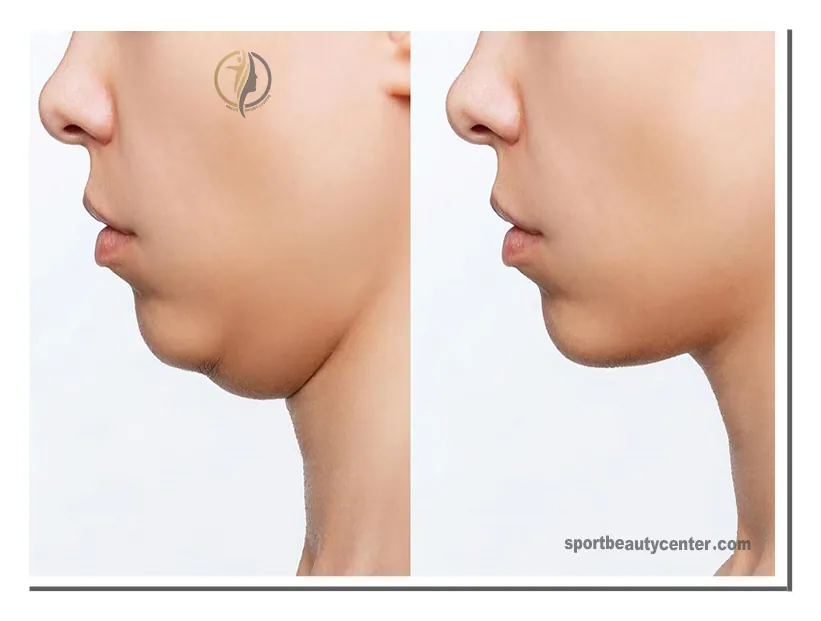 مواد تشکیل دهنده مزوتراپی غبغب