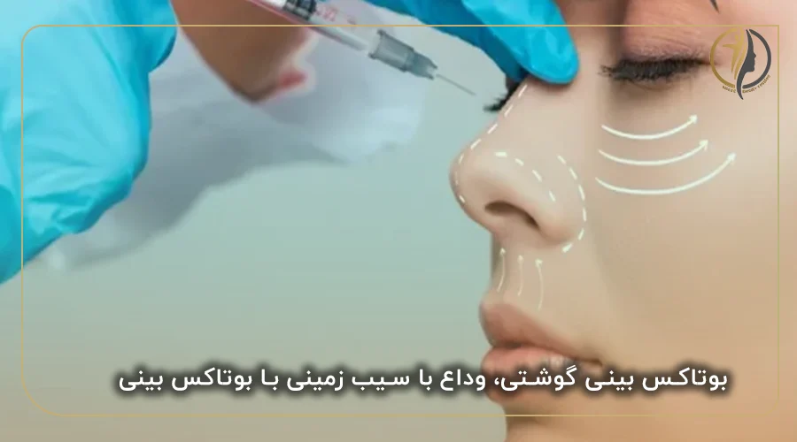 بوتاکس بینی گوشتی، وداع با سیب زمینی با بوتاکس بینی