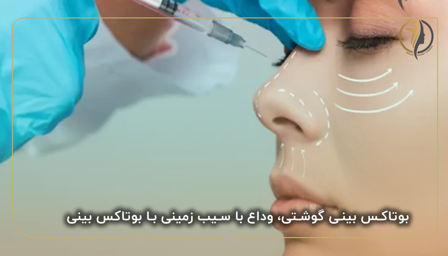 بوتاکس بینی گوشتی، وداع با سیب زمینی با بوتاکس بینی