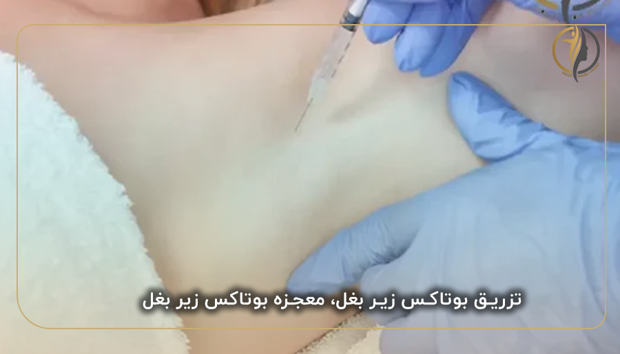 تزریق بوتاکس زیر بغل، معجزه بوتاکس زیر بغل