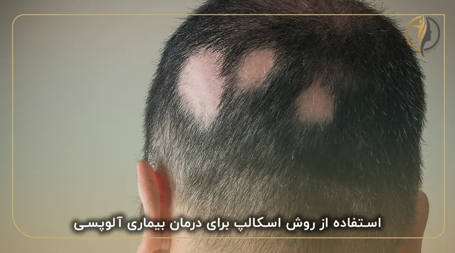 اسکالپ سر برای بیماران آلوپسی