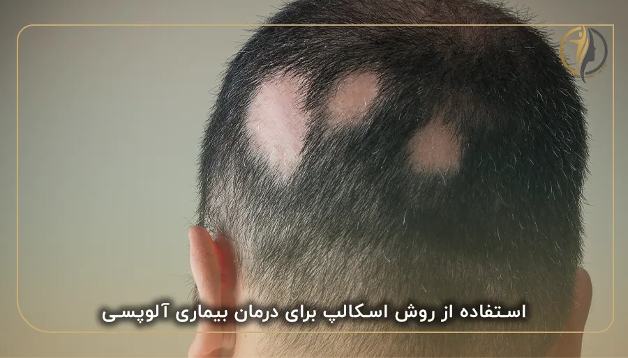 اسکالپ سر برای بیماران آلوپسی