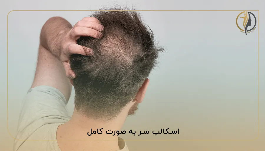 اسکالپ سر به صورت کامل
