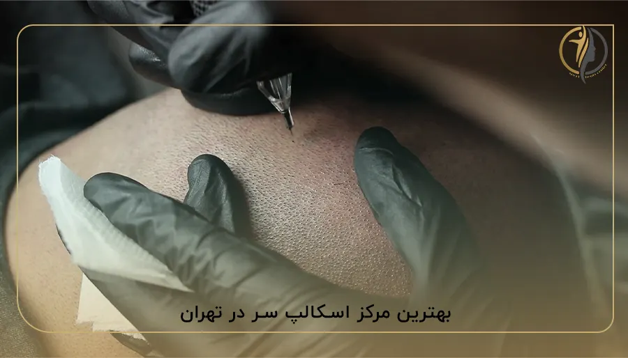 بهترین مرکز اسکالپ سر در تهران