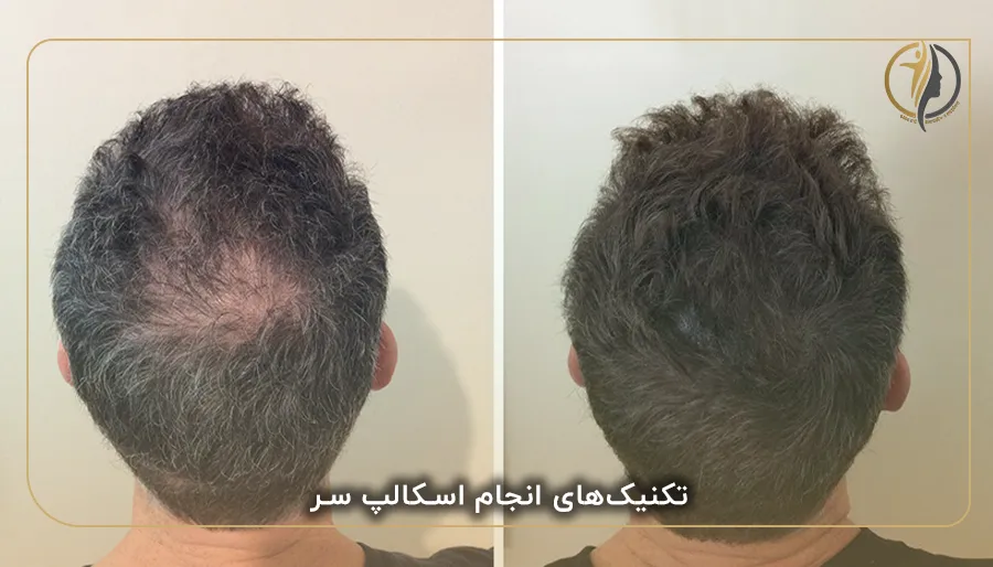 تکنیک‌های انجام اسکالپ سر