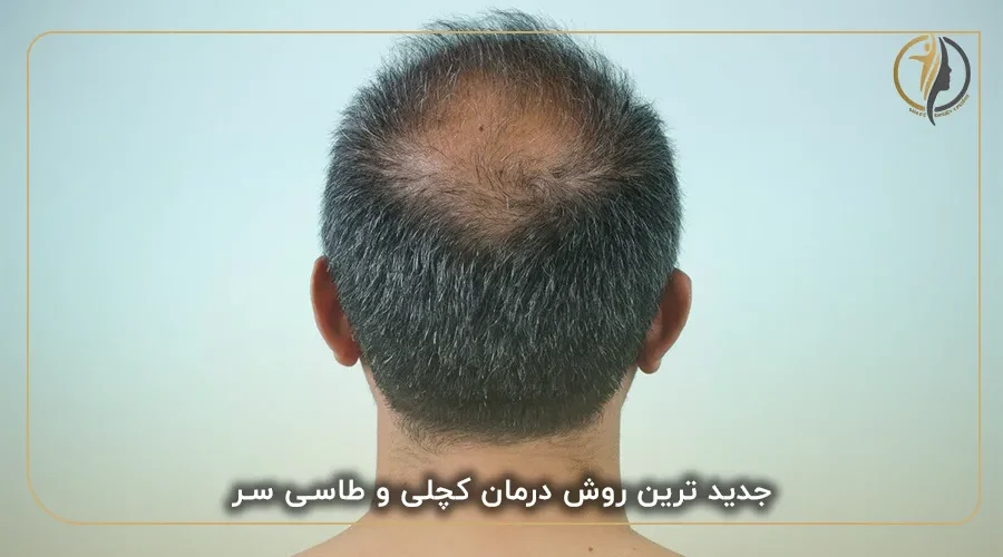 جدید ترین روش درمان کچلی و طاسی سر