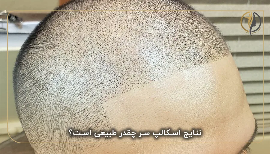 زمان بهبودی بعد از اسکالپ موی سر چقدر است؟