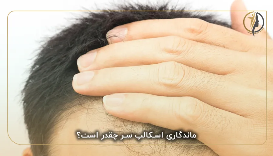 ماندگاری اسکالپ سر چقدر است؟