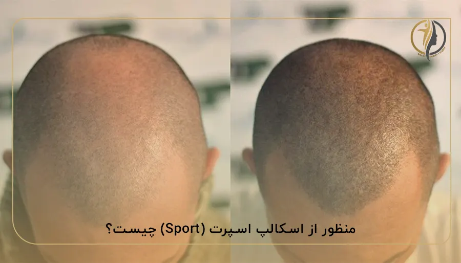 منظور از اسکالپ اسپرت (Sport) چیست؟