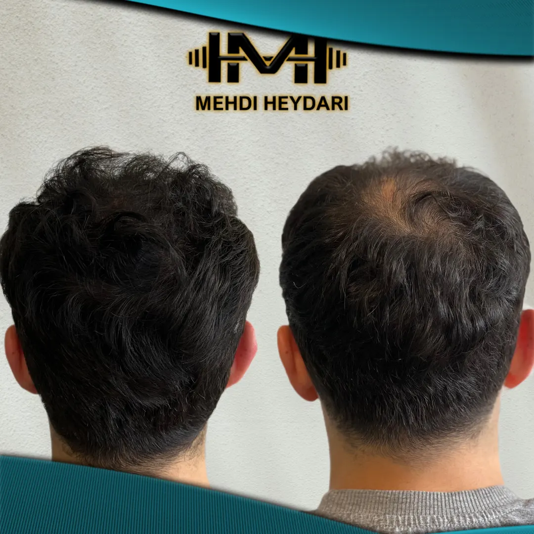 نمونه اسکالپ سر تهران