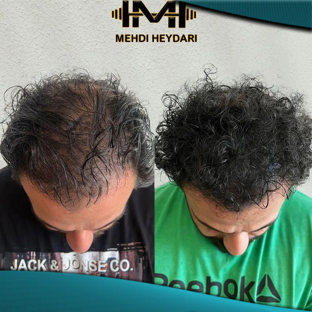 نمونه اسکالپ سر