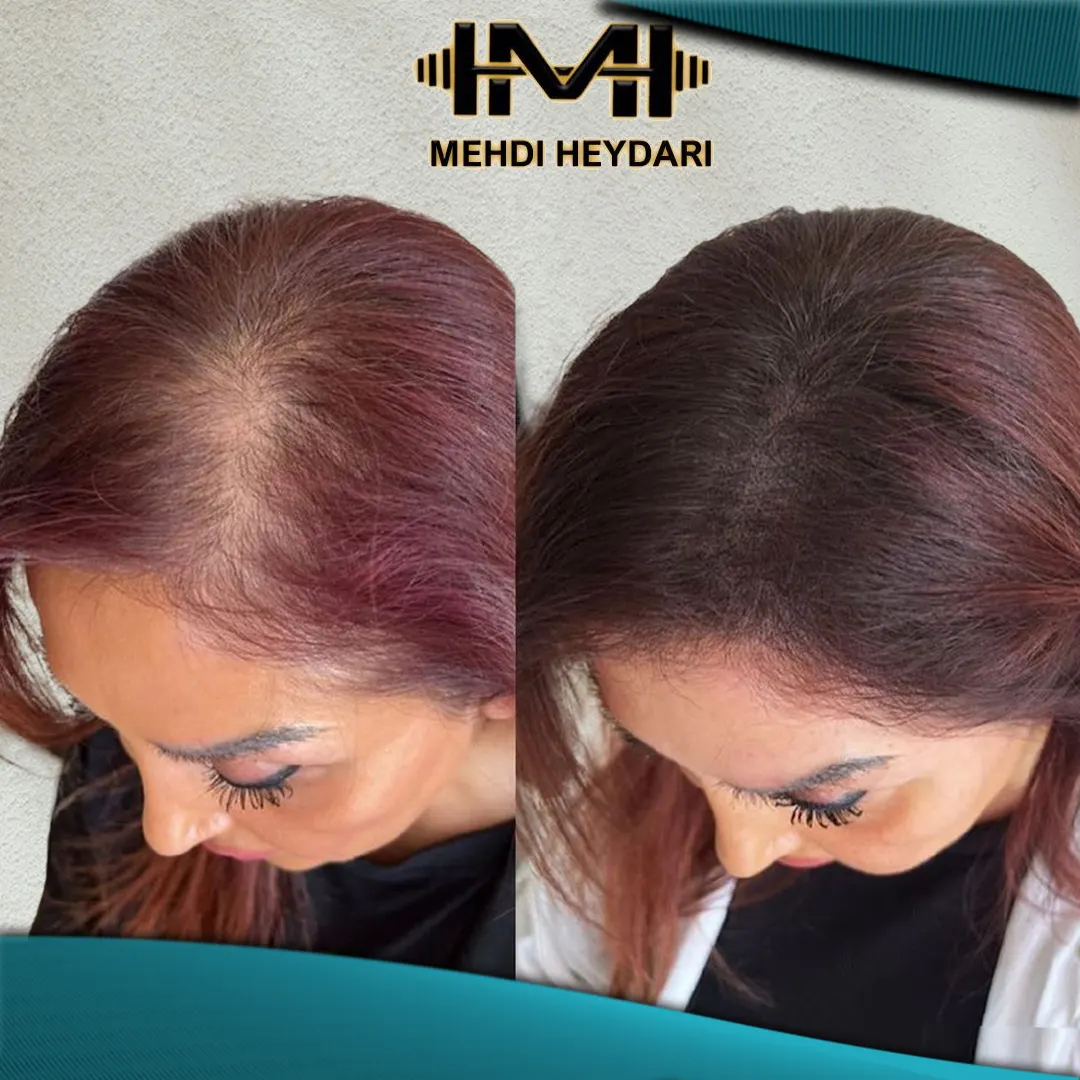 نمونه میکرو اسکالپ سر