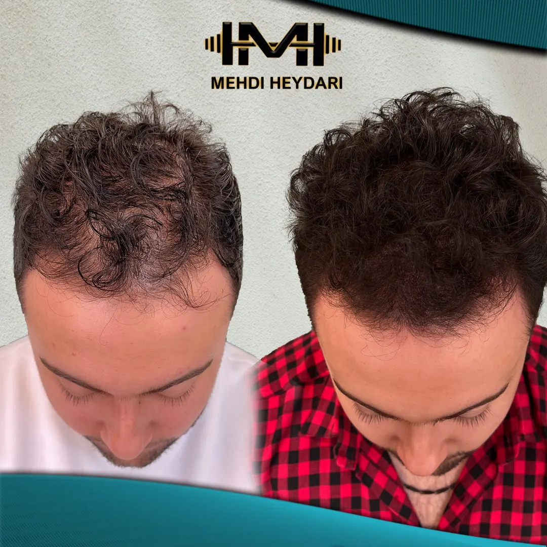 نمونه پر پشتی مو اسکالپ سر