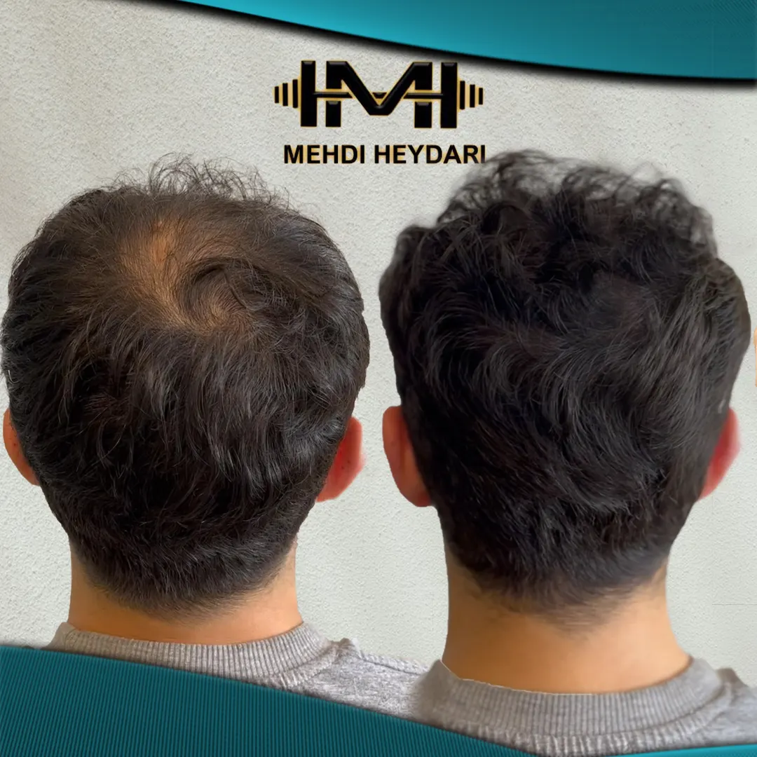 نمونه کار اسکالپ سر در تهران