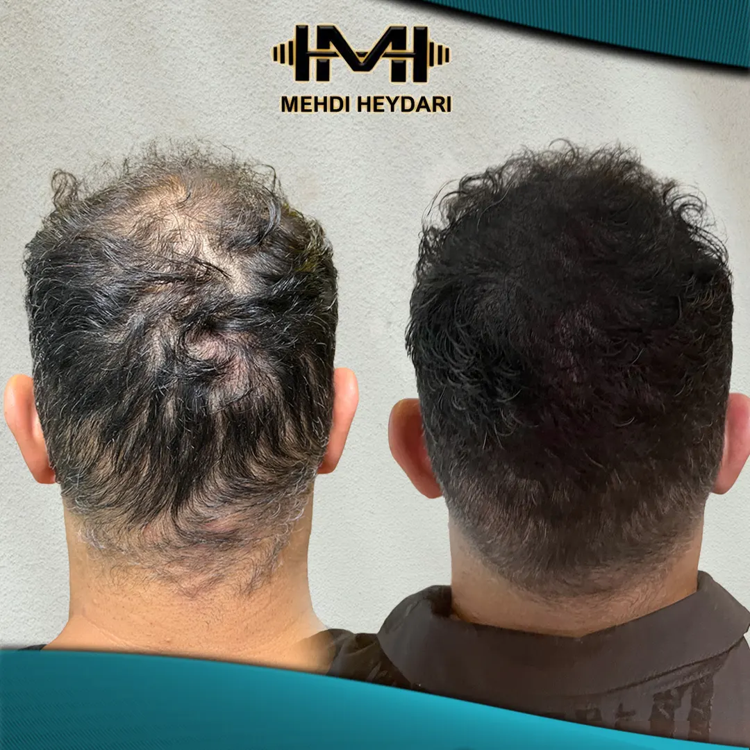 نمونه کار اسکالپ سر