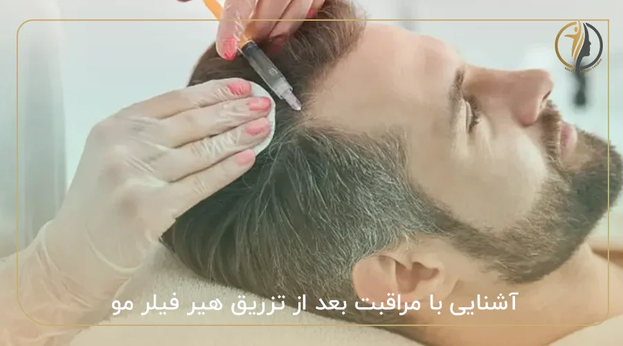 آشنایی با مراقبت بعد از تزریق هیر فیلر مو