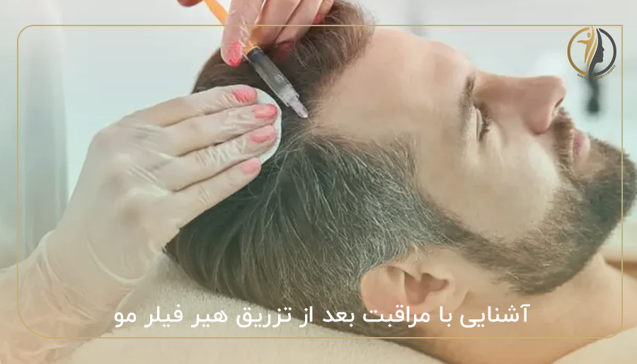 آشنایی با مراقبت بعد از تزریق هیر فیلر مو
