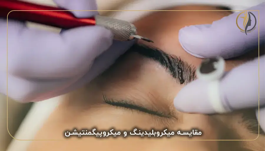 مقایسه میکروبلیدینگ و میکروپیگمنتیشن