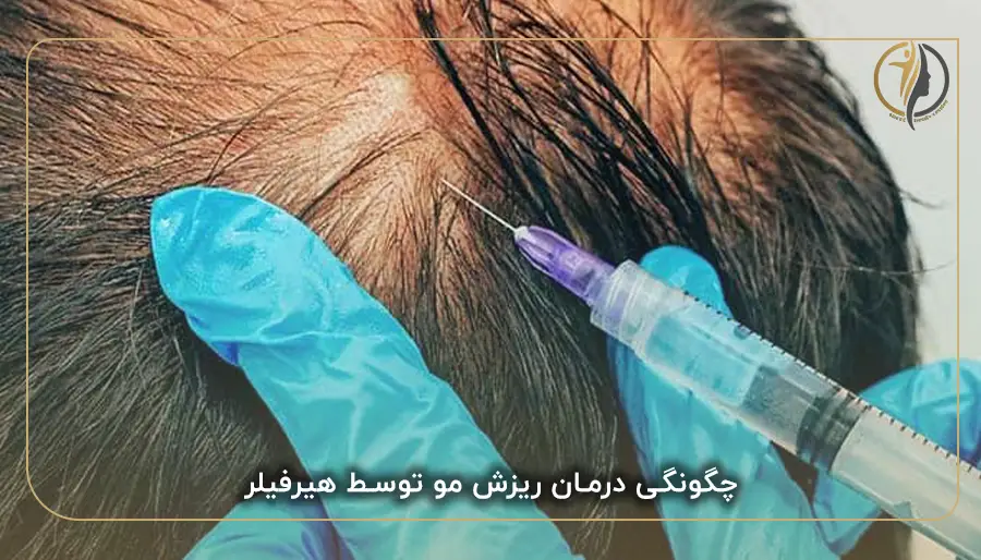 چگونگی درمان ریزش مو توسط هیرفیلر