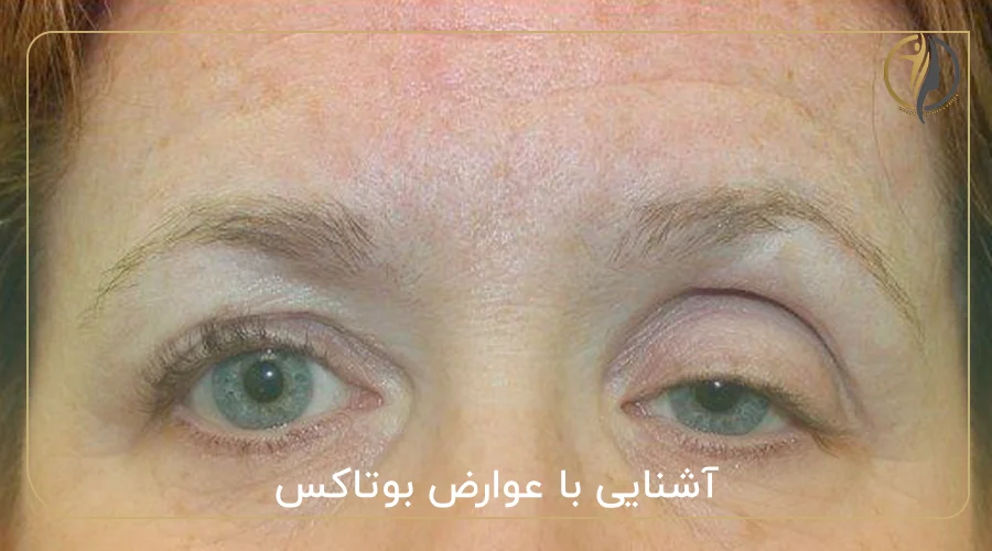 آشنایی با عوارض بوتاکس