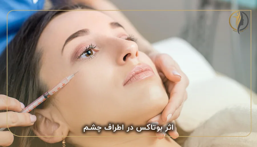 اثر بوتاکس در اطراف چشم