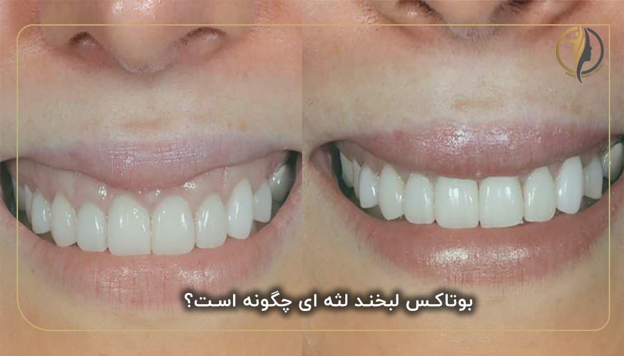 بوتاکس لبخند لثه ای چگونه است؟