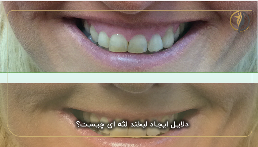 دلایل ایجاد لبخند لثه‌ ای چیست؟