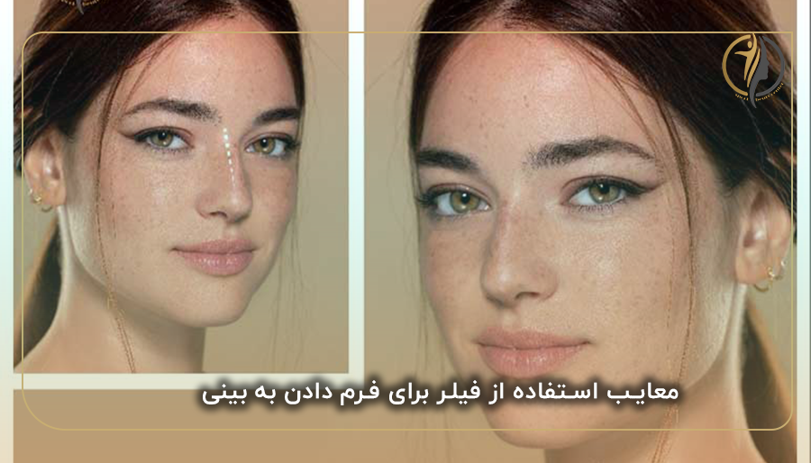 معایب استفاده از فیلر برای فرم دادن به بینی