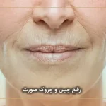 رفع چین و چروک صورت