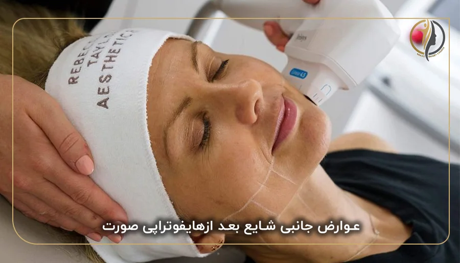 عوارض جانبی شایع بعد ازهایفوتراپی صورت