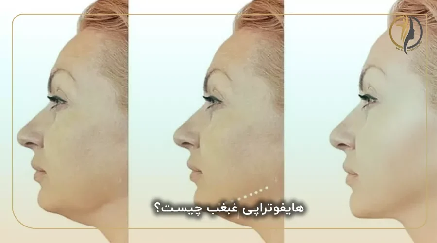 هایفوتراپی غبغب چیست؟