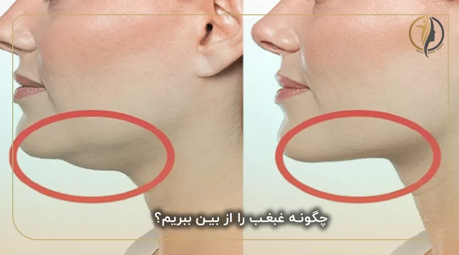 چگونه غبغب را از بین ببریم؟